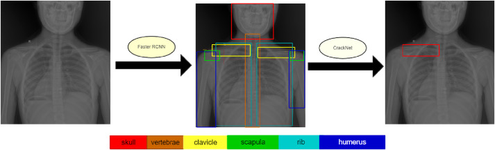 Fracture Detection Project